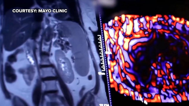 Healthy SA: Battling liver cancer, a disease which often has no symptoms early on — KENS 5 (San Antonio), Mayville Health news